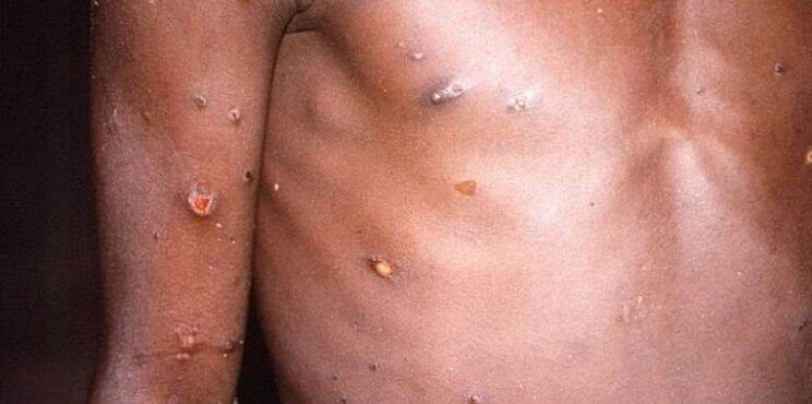 No confirmed case of Monkeypox in Western Region – GHS