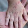 • As at Thursday, Ghana has recorded five cases of monkeypox