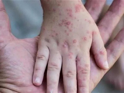 Monkeypox outbreak 2022 …and what you need to know