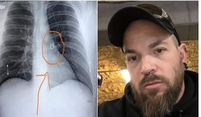 Man’s lost nose ring found in his lung