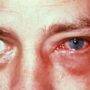 An appollo infected eye