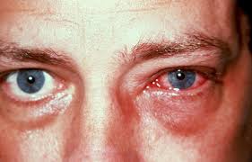 Acute Hemorrhagic Conjunctivitis (Apollo/Pink Eye)