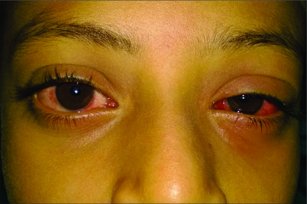 Both eyes infected with  appollo