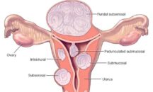 Fibroid… Threat to female reproductive health