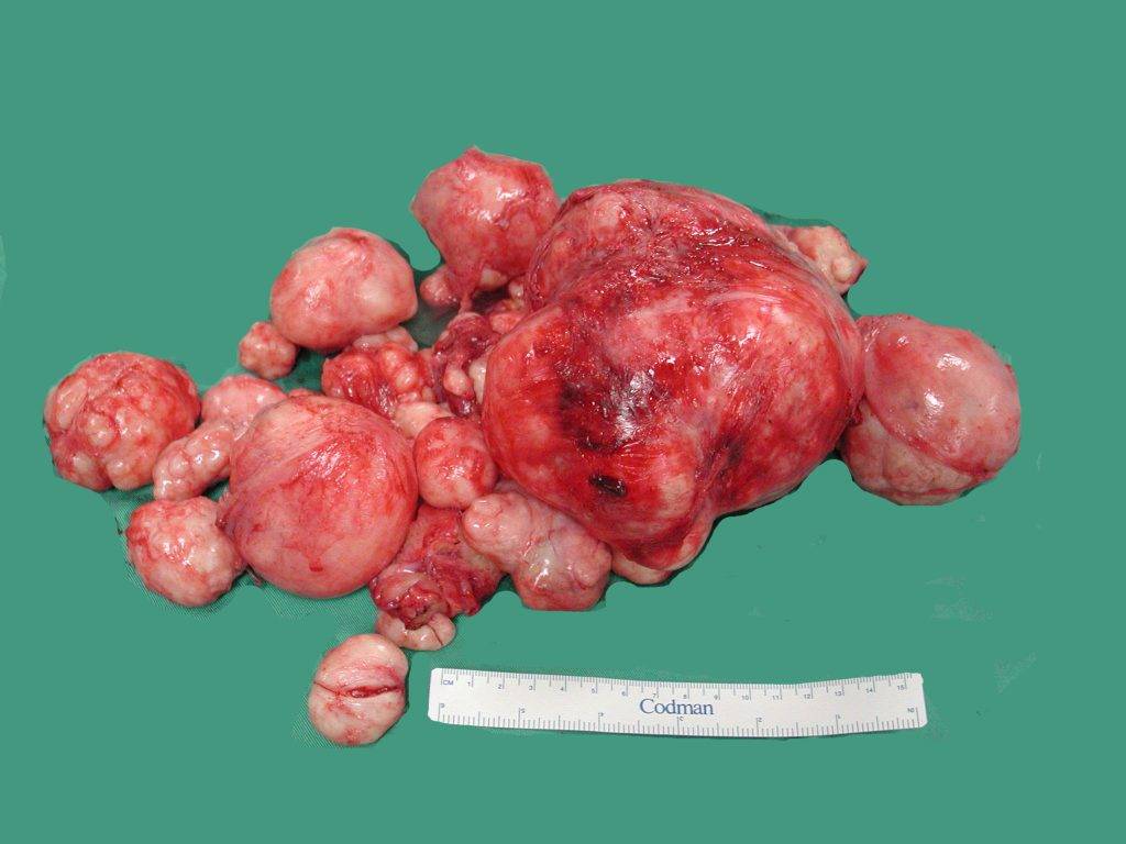 A specimen of multiple uterine fibroids