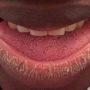 Harmattan can cause chapped lips